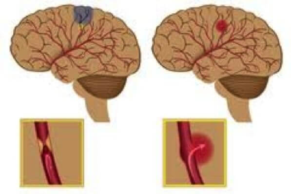 Herseninfarct en hersenbloeding